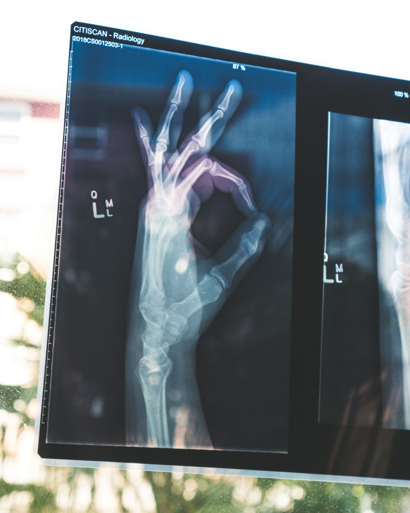 osteopenia